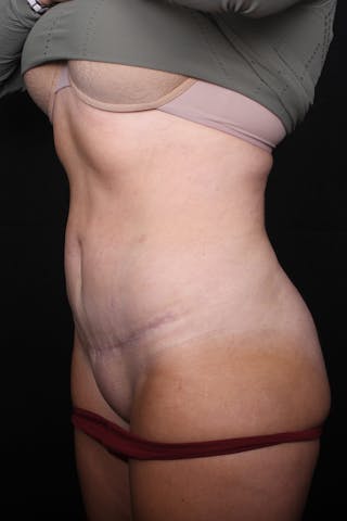 Abdominoplasty Before & After Gallery - Patient 255400 - Image 8
