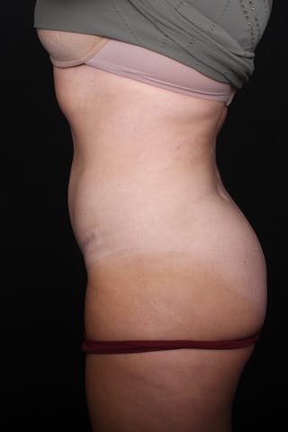 Abdominoplasty Before & After Gallery - Patient 255400 - Image 10