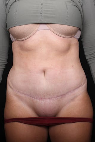 Abdominoplasty Before & After Gallery - Patient 255400 - Image 2