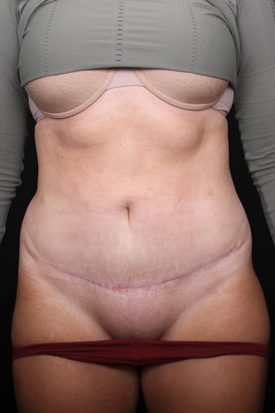 Abdominoplasty (No Diastasis) Before & After Gallery - Patient 255400 - Image 2