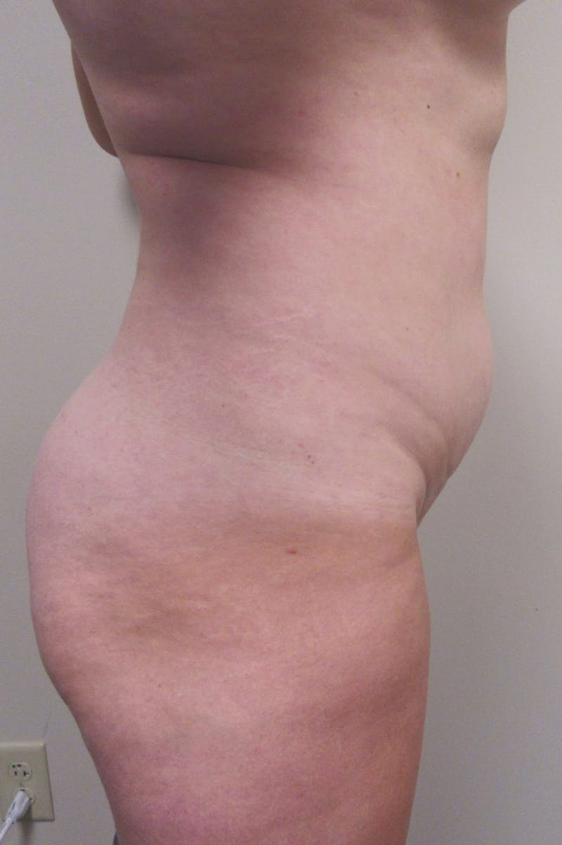 Abdominoplasty Before & After Gallery - Patient 255400 - Image 5