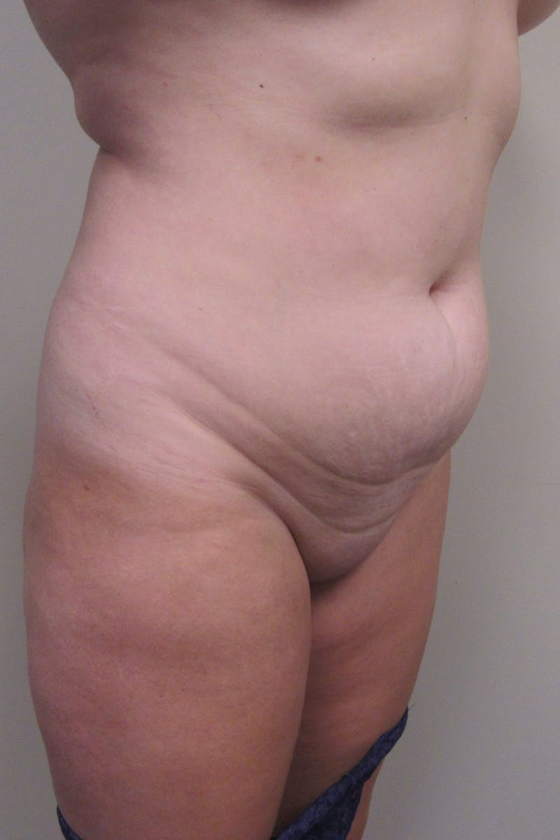 Abdominoplasty Before & After Gallery - Patient 255400 - Image 3