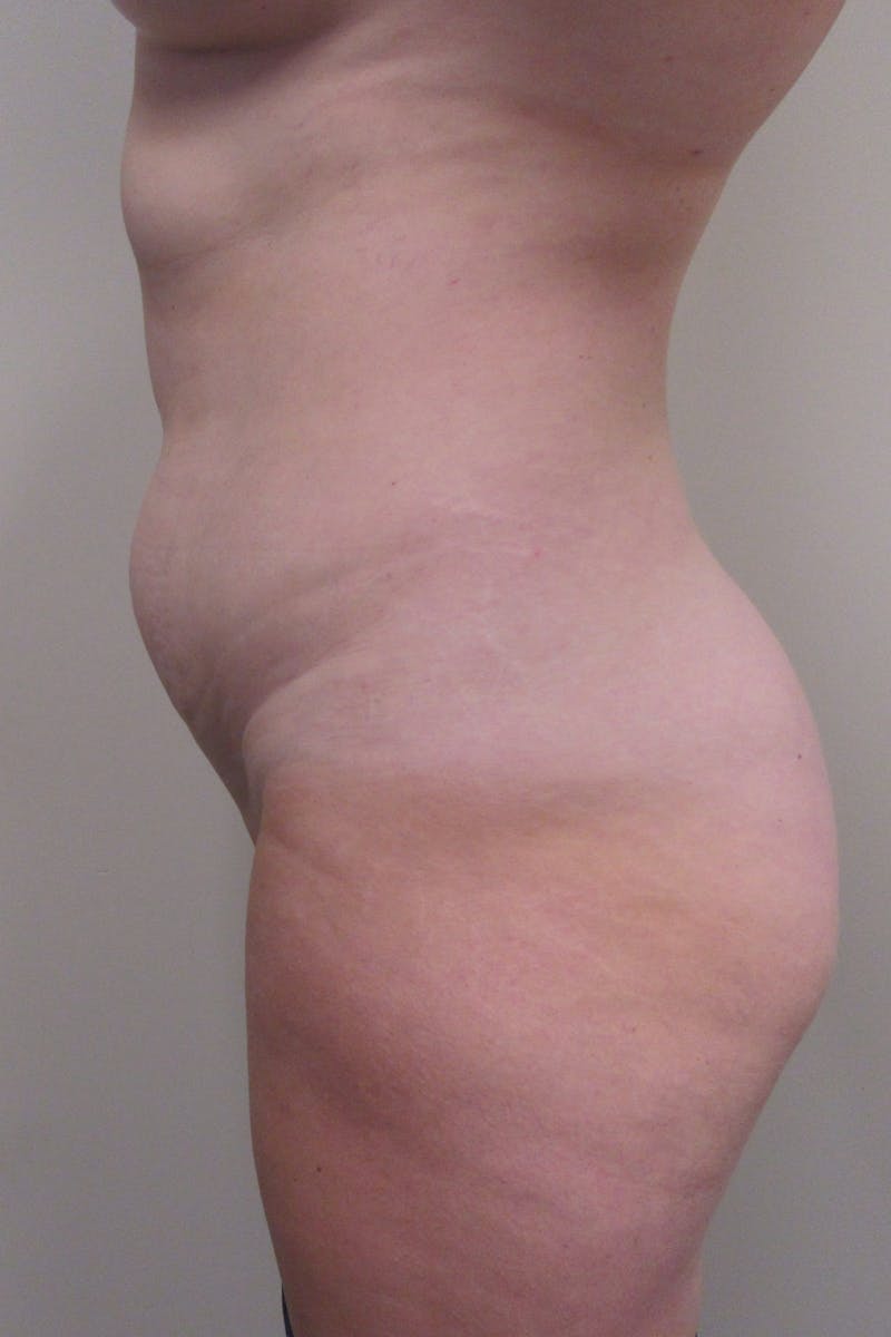 Abdominoplasty Before & After Gallery - Patient 255400 - Image 9