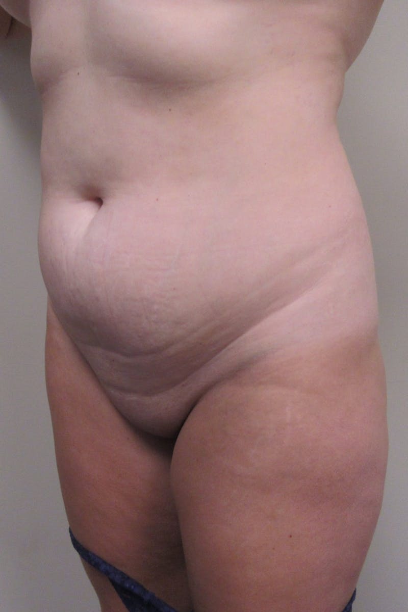 Abdominoplasty Before & After Gallery - Patient 255400 - Image 7