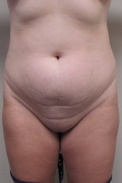 Abdominoplasty Before & After Gallery - Patient 255400 - Image 1