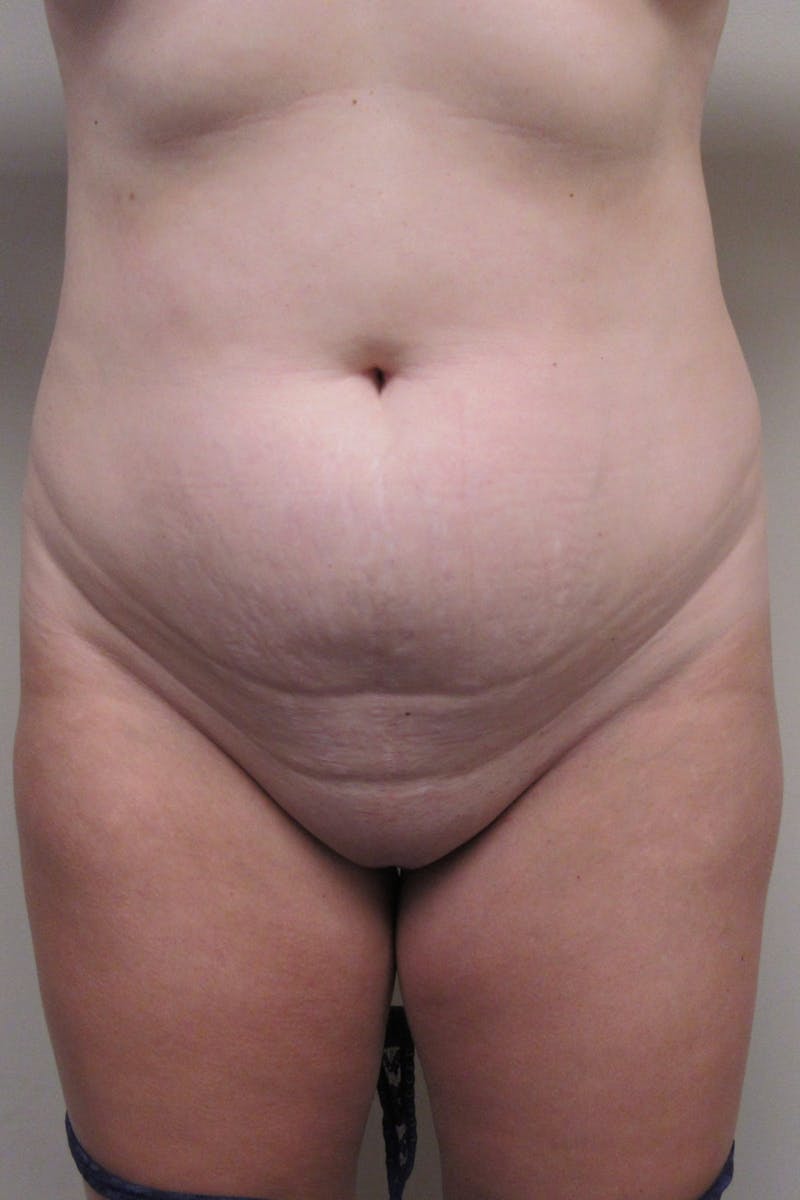 Abdominoplasty Before & After Gallery - Patient 255400 - Image 1