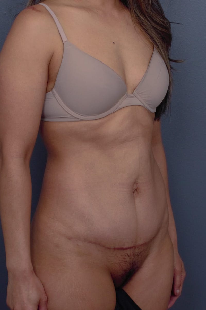 Abdominoplasty Before & After Gallery - Patient 190712 - Image 4