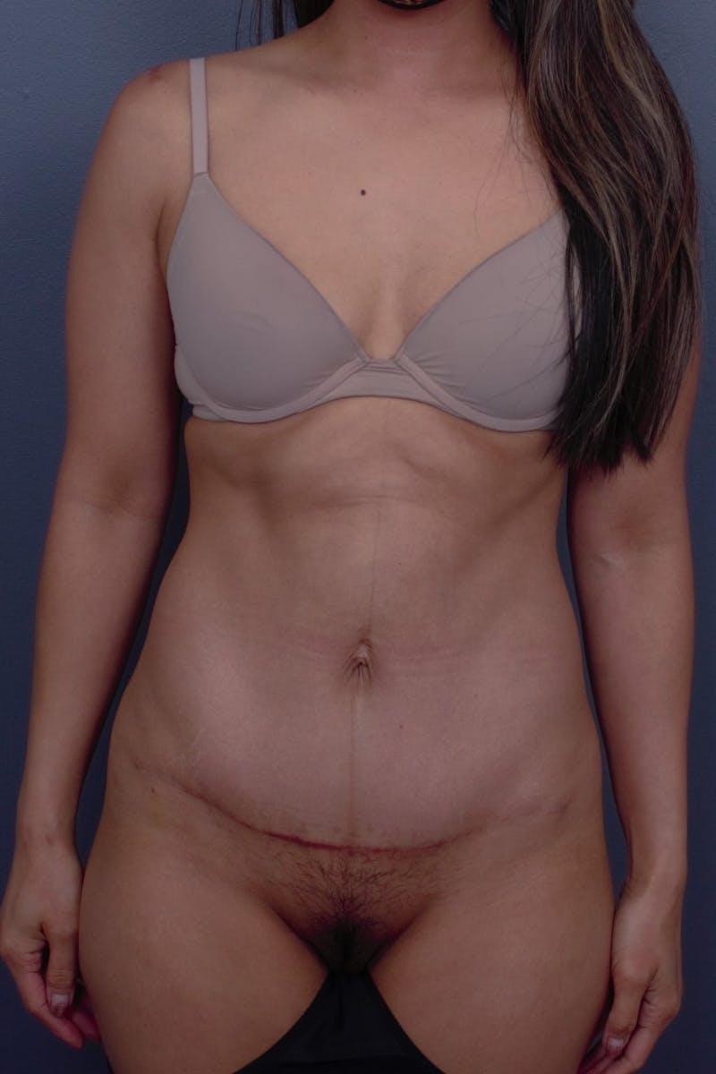 Abdominoplasty Before & After Gallery - Patient 190712 - Image 2