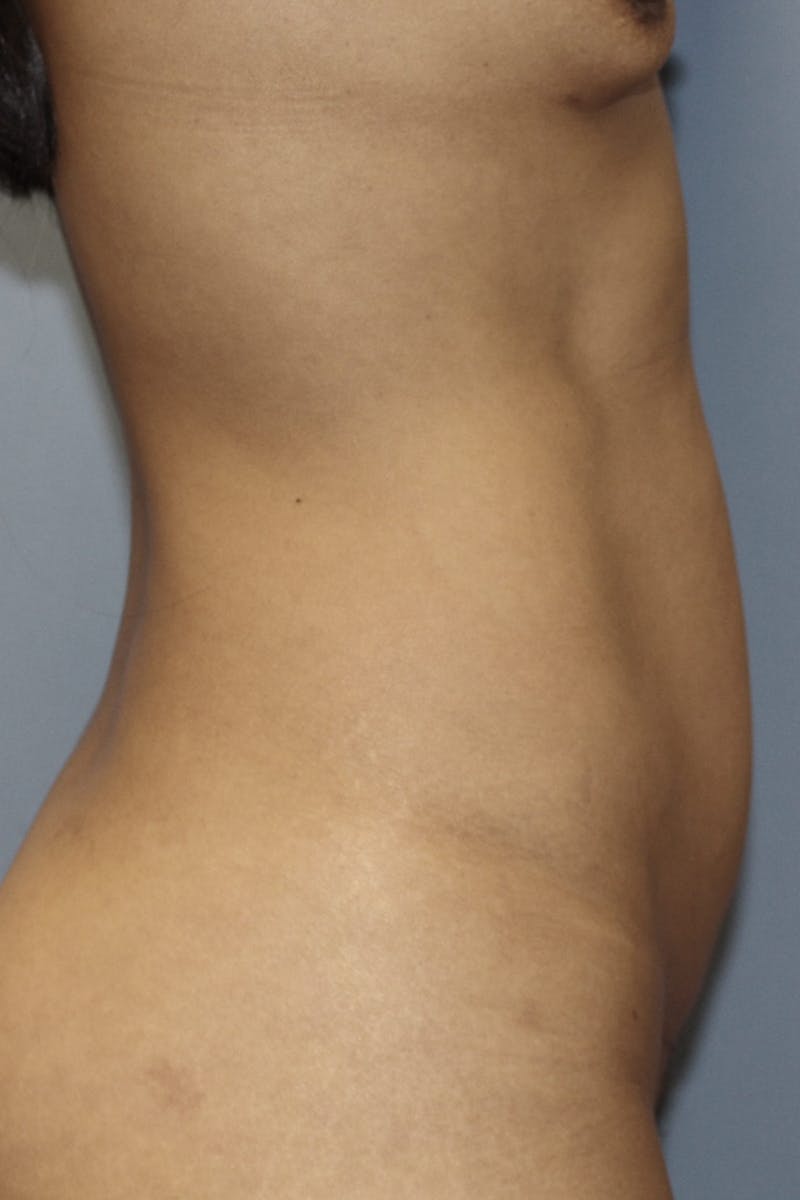 Abdominoplasty Before & After Gallery - Patient 190712 - Image 5