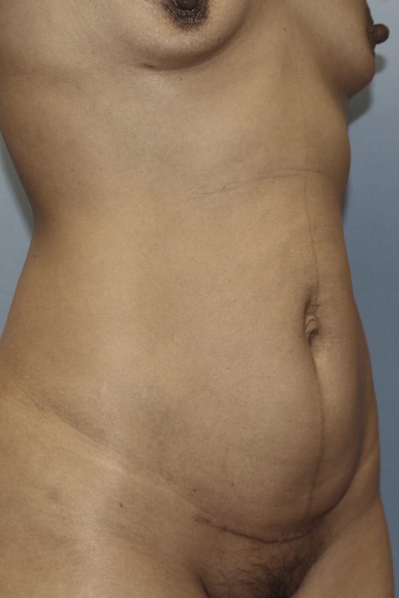 Abdominoplasty Before & After Gallery - Patient 190712 - Image 3