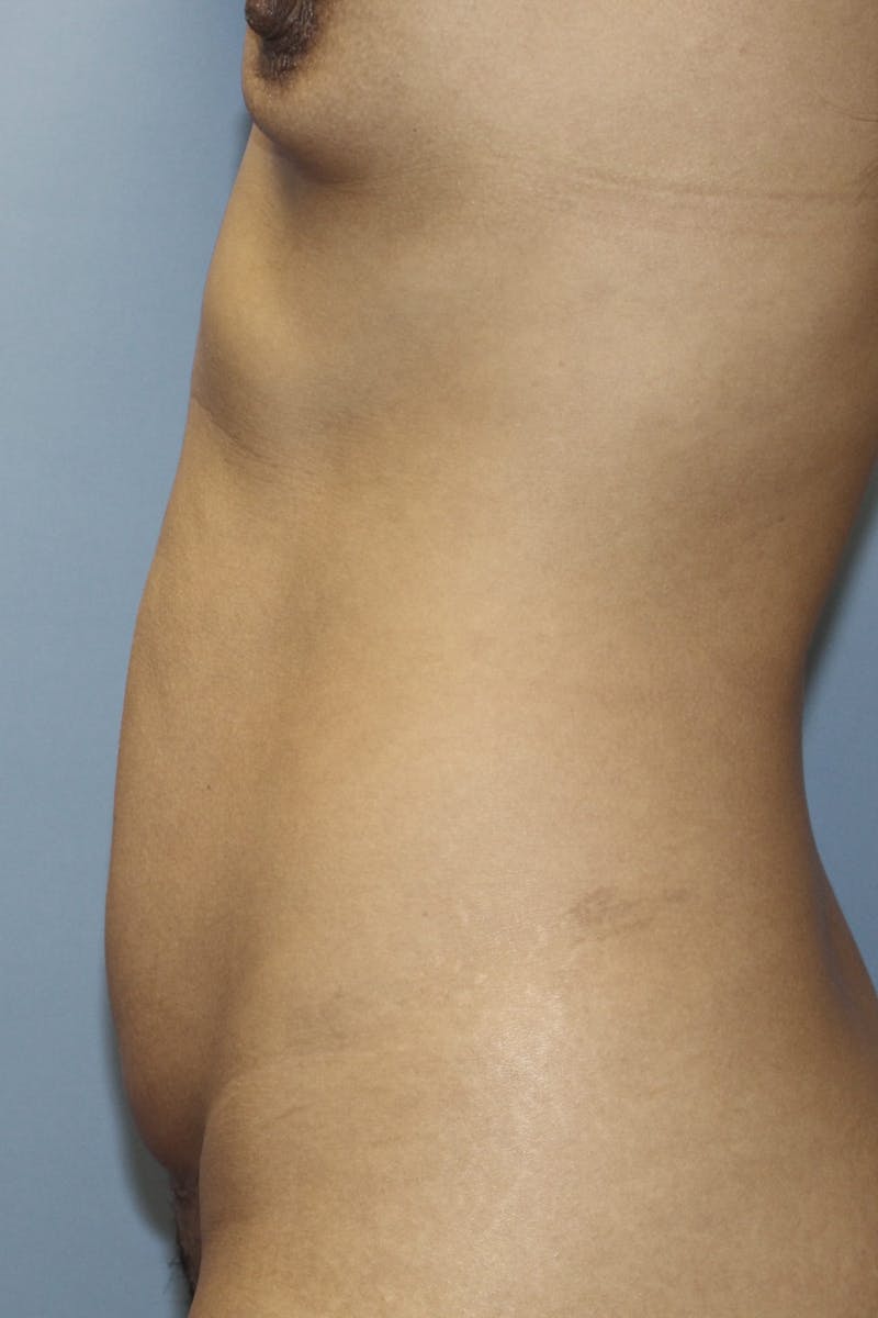 Abdominoplasty Before & After Gallery - Patient 190712 - Image 7