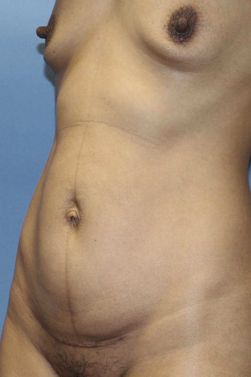 Abdominoplasty Before & After Gallery - Patient 190712 - Image 9