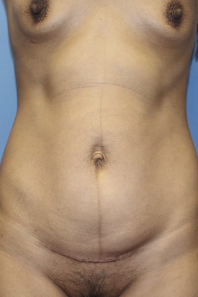 Abdominoplasty Before & After Gallery - Patient 190712 - Image 1