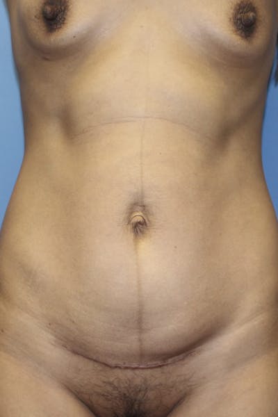 Abdominoplasty (No Diastasis) Before & After Gallery - Patient 190712 - Image 1