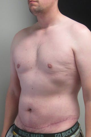 Abdominoplasty Before & After Gallery - Patient 396897 - Image 6