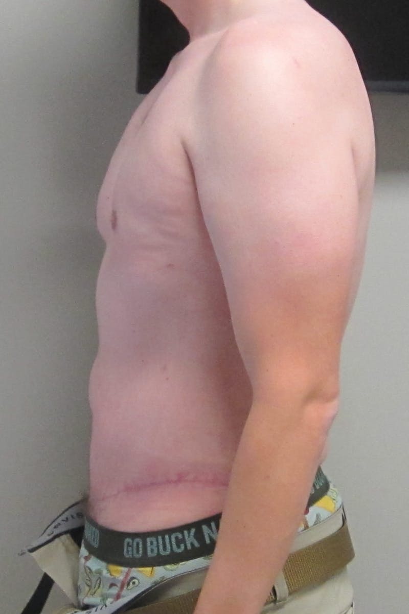 Abdominoplasty Before & After Gallery - Patient 396897 - Image 4