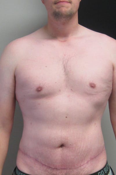 Abdominoplasty (No Diastasis) Before & After Gallery - Patient 396897 - Image 2