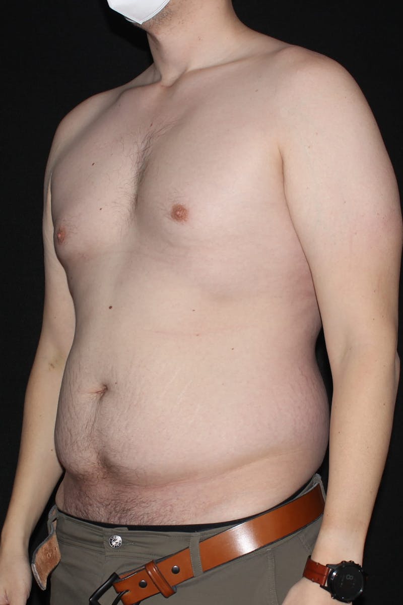 Abdominoplasty Before & After Gallery - Patient 396897 - Image 5