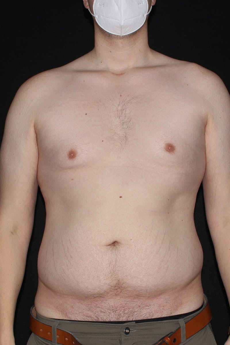 Abdominoplasty Before & After Gallery - Patient 396897 - Image 1