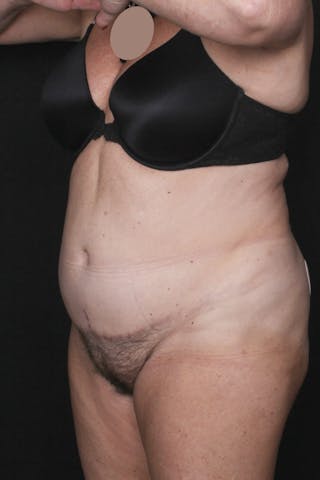 Abdominoplasty Before & After Gallery - Patient 396263 - Image 4