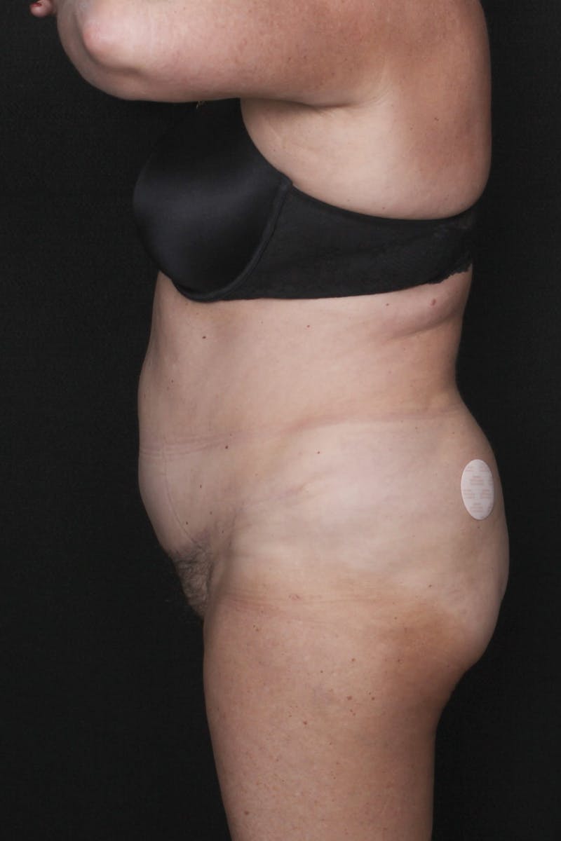 Abdominoplasty (With Diastasis) Before & After Gallery - Patient 301937 - Image 6