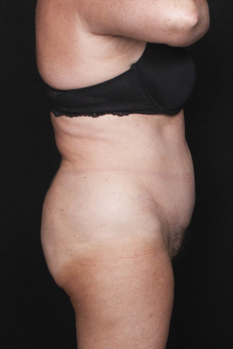 Abdominoplasty (With Diastasis) Before & After Gallery - Patient 301937 - Image 10