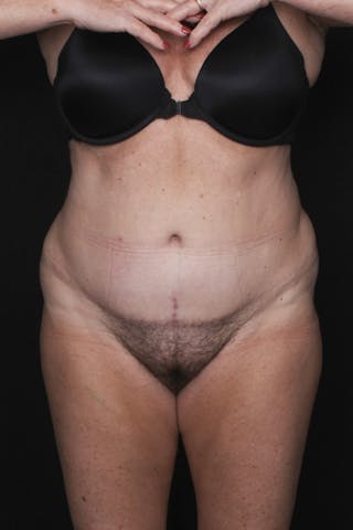 Abdominoplasty Before & After Gallery - Patient 396263 - Image 2