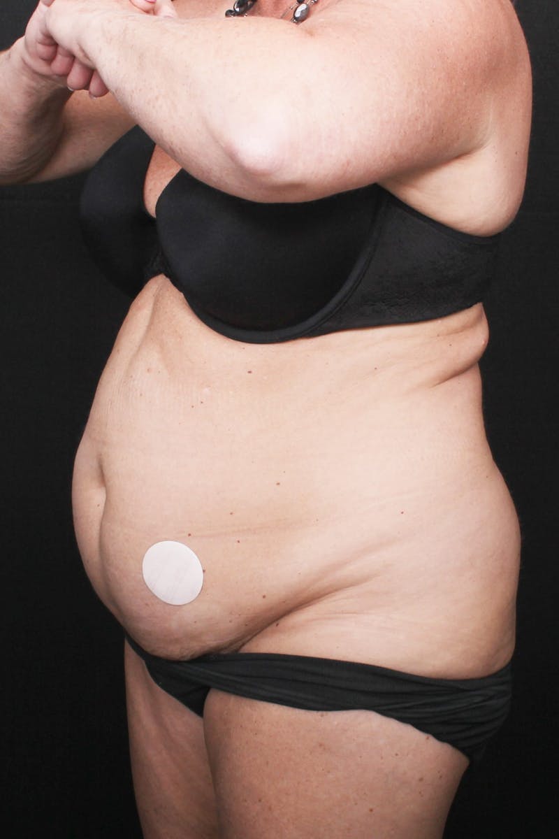 Abdominoplasty Before & After Gallery - Patient 396263 - Image 3