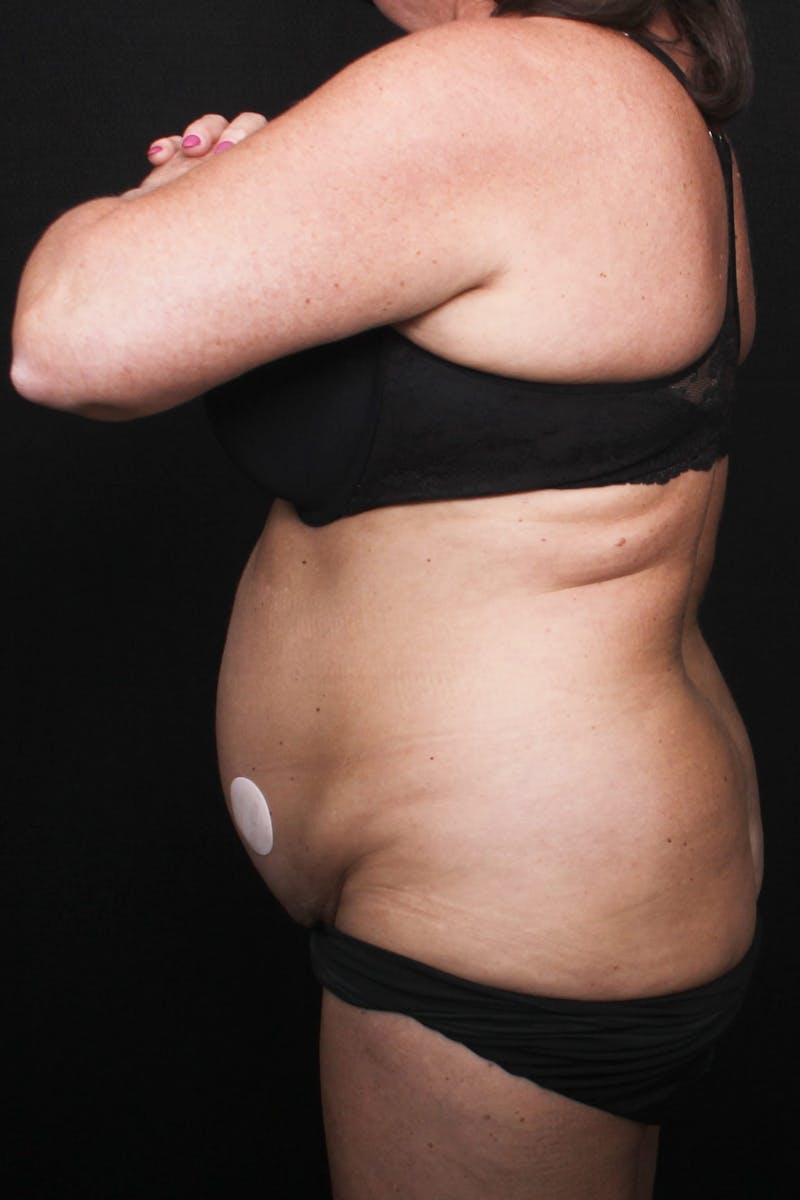 Abdominoplasty Before & After Gallery - Patient 396263 - Image 5