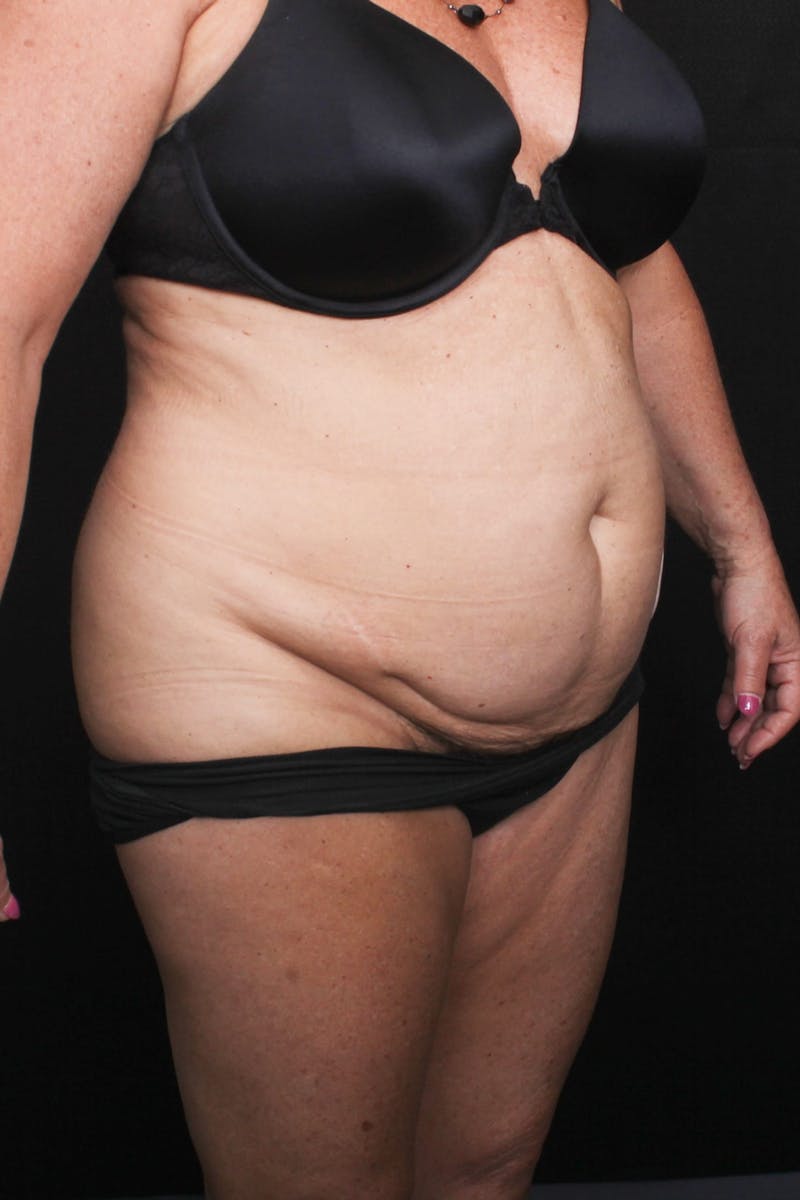 Abdominoplasty (With Diastasis) Before & After Gallery - Patient 301937 - Image 7