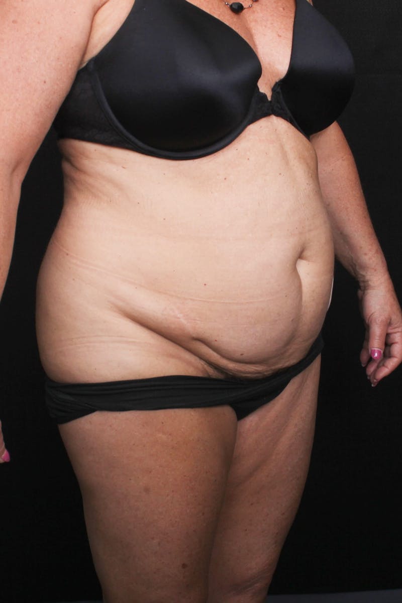Abdominoplasty Before & After Gallery - Patient 396263 - Image 7