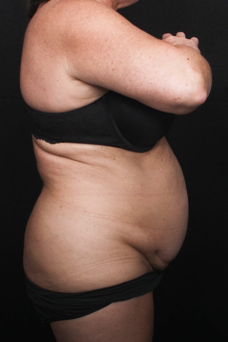 Abdominoplasty Before & After Gallery - Patient 396263 - Image 9