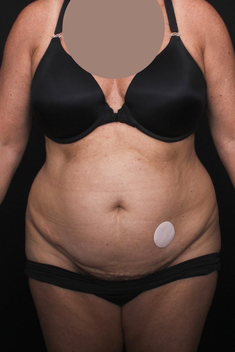 Abdominoplasty Before & After Gallery - Patient 396263 - Image 1