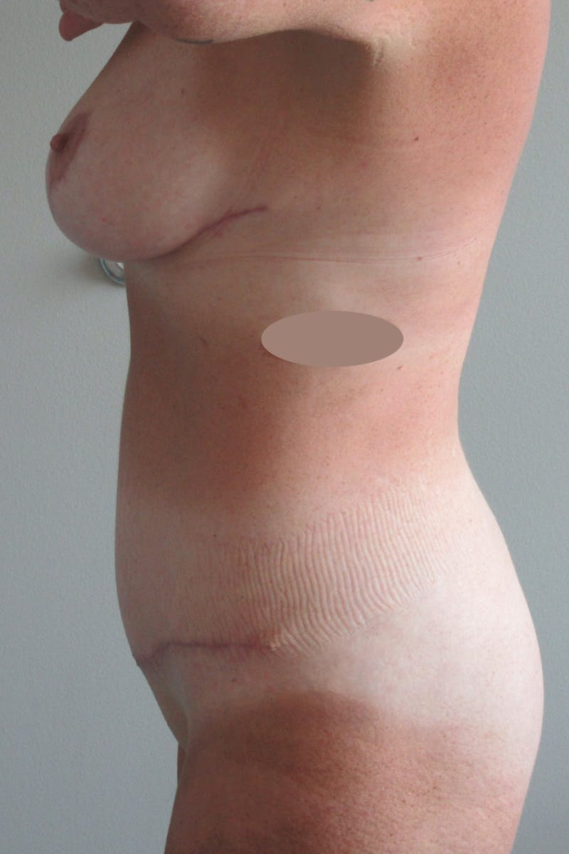 Abdominoplasty (With Diastasis) Before & After Gallery - Patient 355191 - Image 4