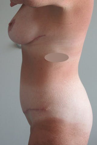 Abdominoplasty Before & After Gallery - Patient 410279 - Image 4