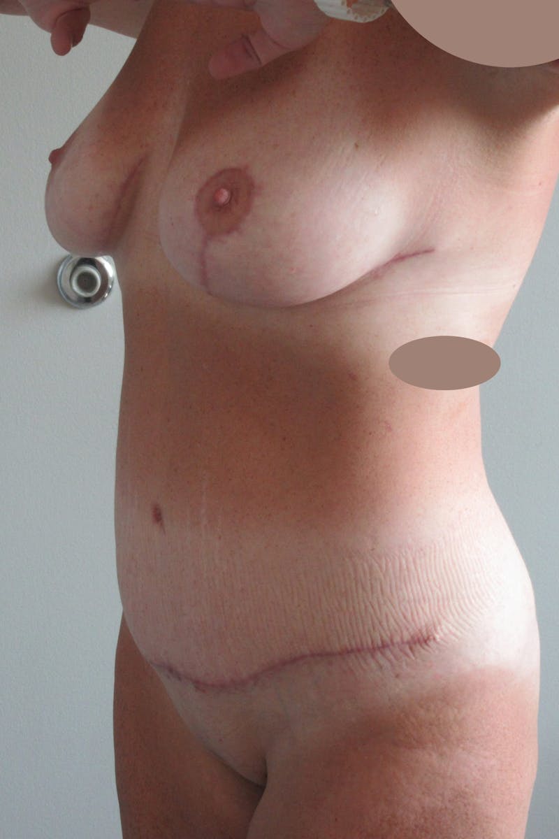 Abdominoplasty (With Diastasis) Before & After Gallery - Patient 355191 - Image 6