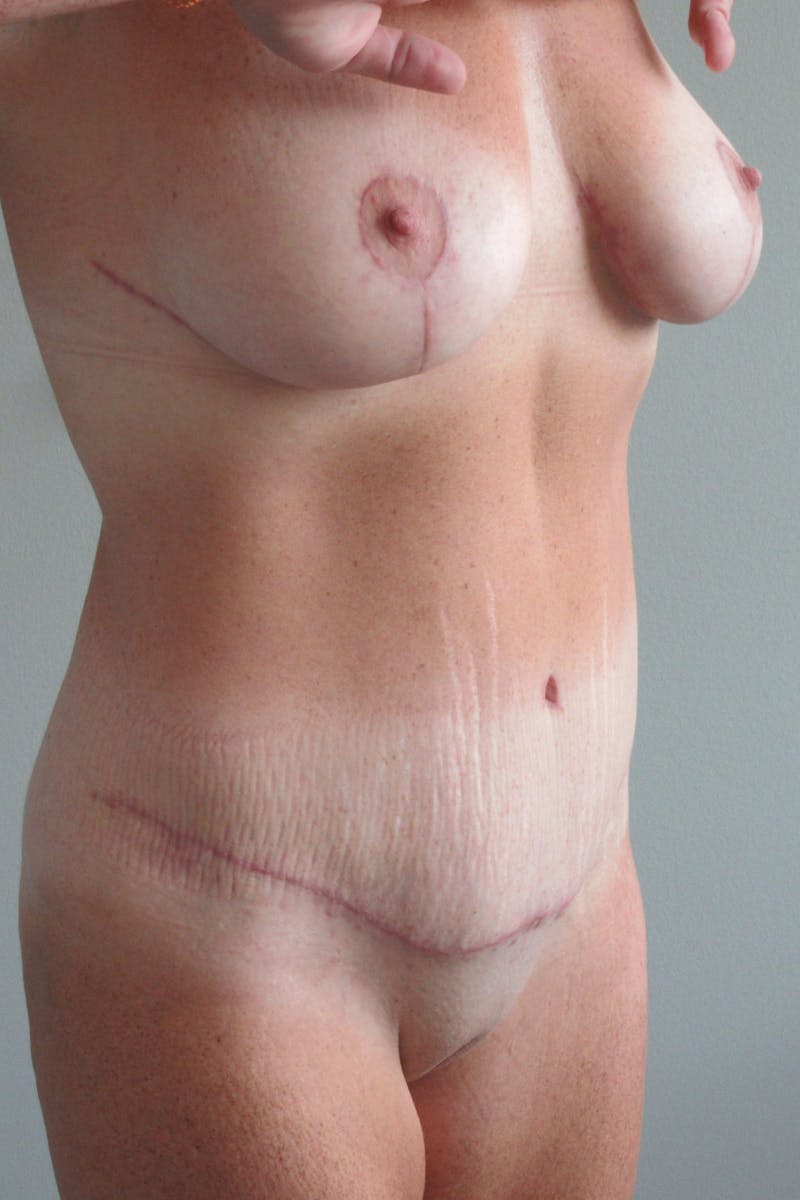 Abdominoplasty (With Diastasis) Before & After Gallery - Patient 355191 - Image 8