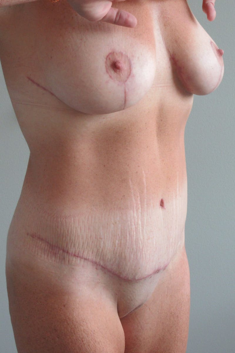 Abdominoplasty Before & After Gallery - Patient 410279 - Image 8