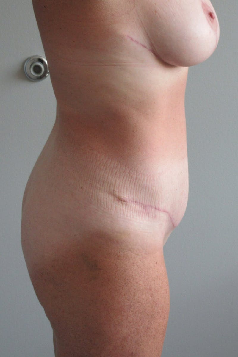 Abdominoplasty (With Diastasis) Before & After Gallery - Patient 355191 - Image 10