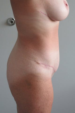 Abdominoplasty Before & After Gallery - Patient 410279 - Image 10