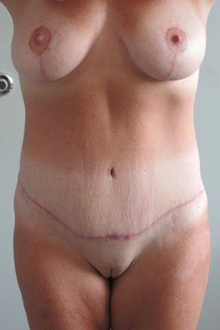 Abdominoplasty Before & After Gallery - Patient 410279 - Image 2