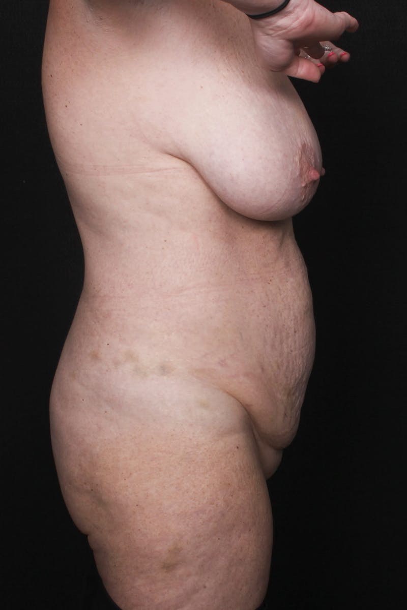 Abdominoplasty (With Diastasis) Before & After Gallery - Patient 355191 - Image 9