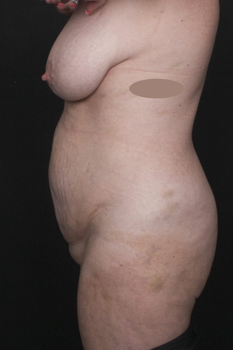 Abdominoplasty Before & After Gallery - Patient 410279 - Image 3