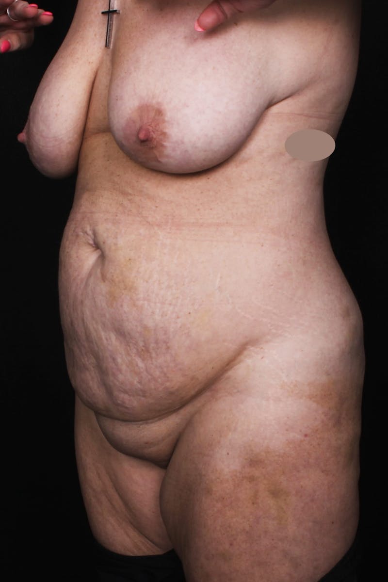 Abdominoplasty Before & After Gallery - Patient 410279 - Image 5