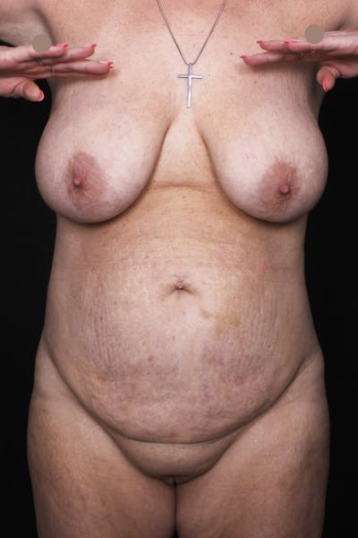 Abdominoplasty Before & After Gallery - Patient 410279 - Image 1