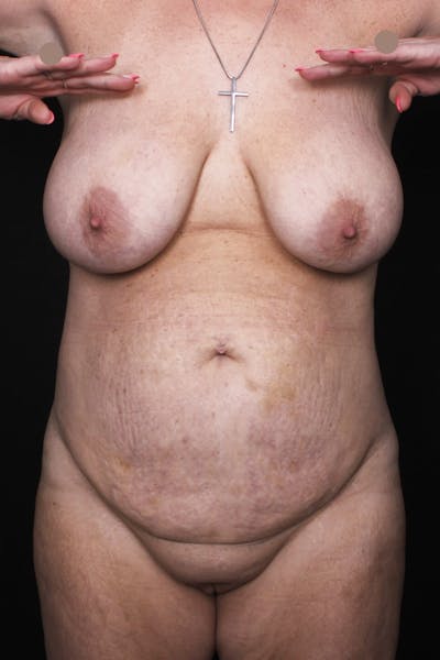 Abdominoplasty (With Diastasis) Before & After Gallery - Patient 355191 - Image 1