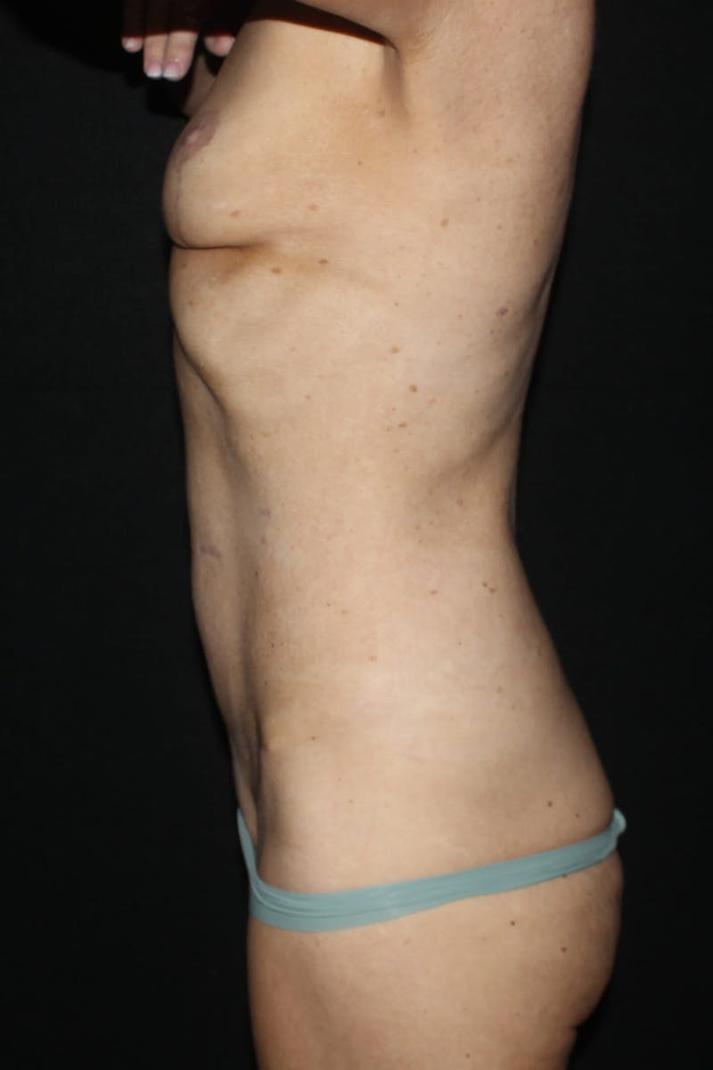 Abdominoplasty (With Diastasis) Before & After Gallery - Patient 405673 - Image 4