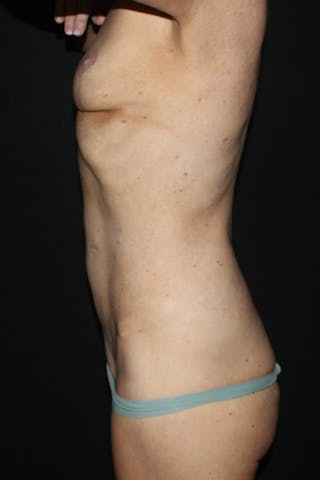 Abdominoplasty Before & After Gallery - Patient 302936 - Image 4