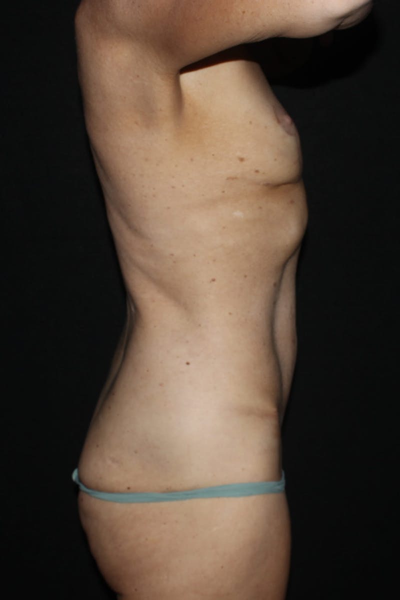 Abdominoplasty (With Diastasis) Before & After Gallery - Patient 405673 - Image 6
