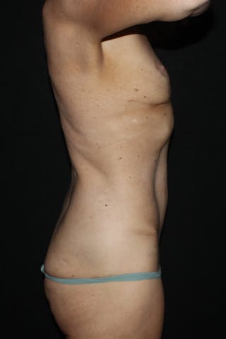 Abdominoplasty Before & After Gallery - Patient 302936 - Image 6